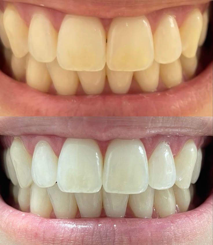 Before teeth whitening