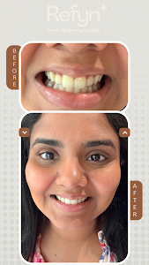 Refyn teeth whitening studio place picture