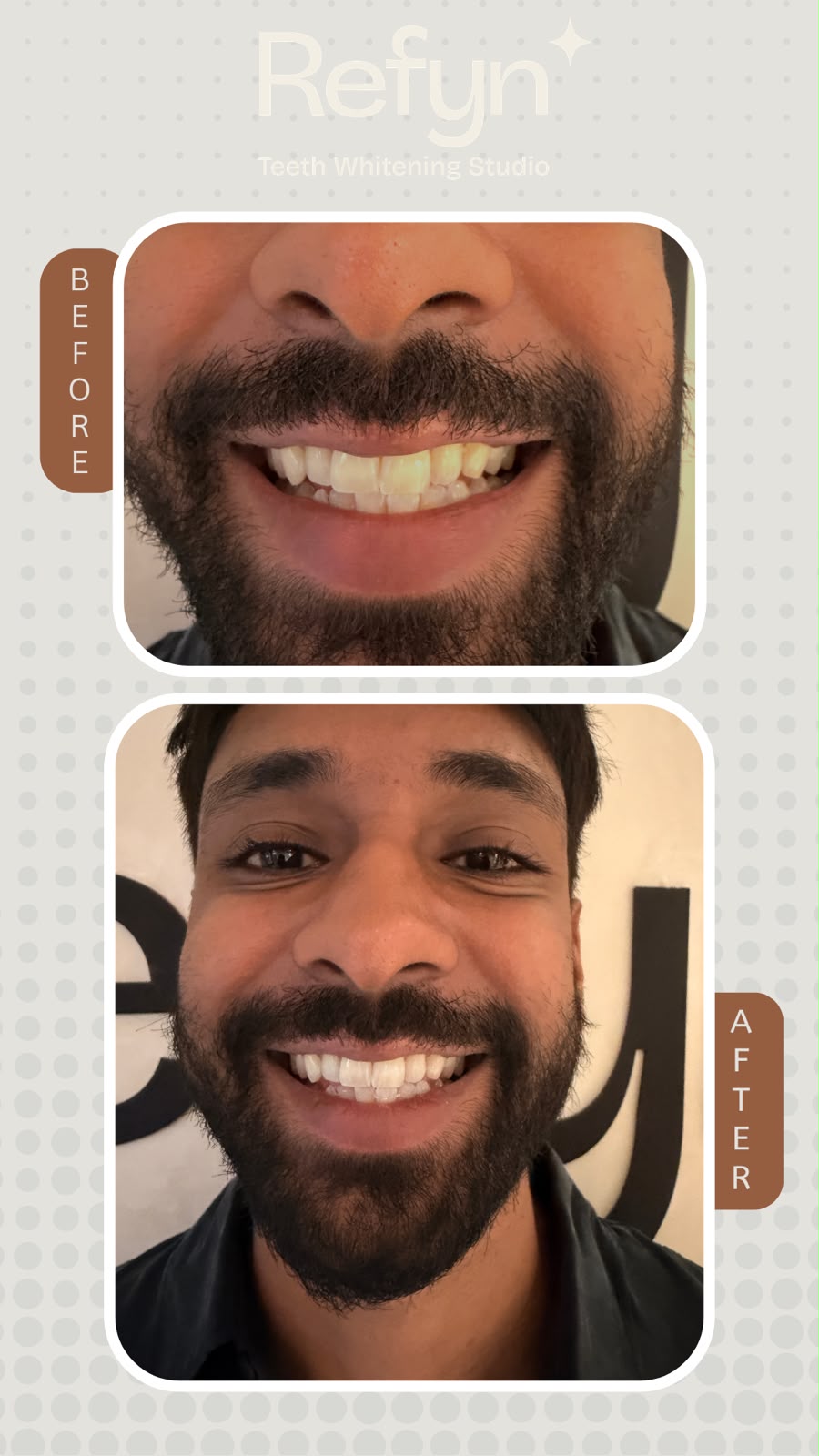 Before teeth whitening — stained enamel