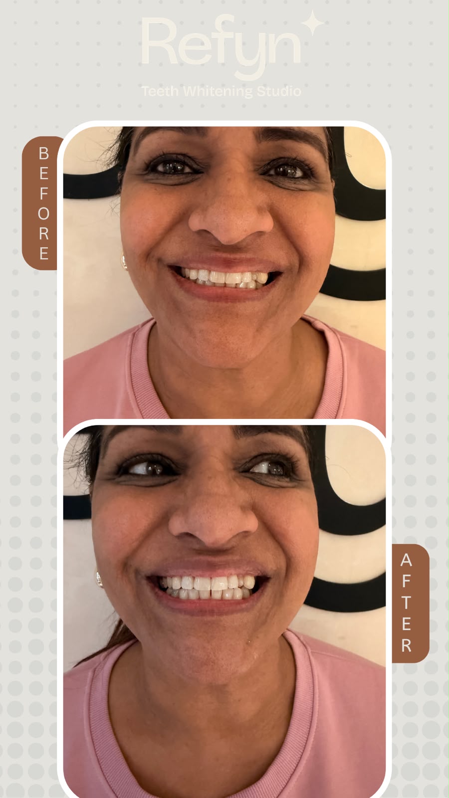 Before teeth whitening — stained enamel