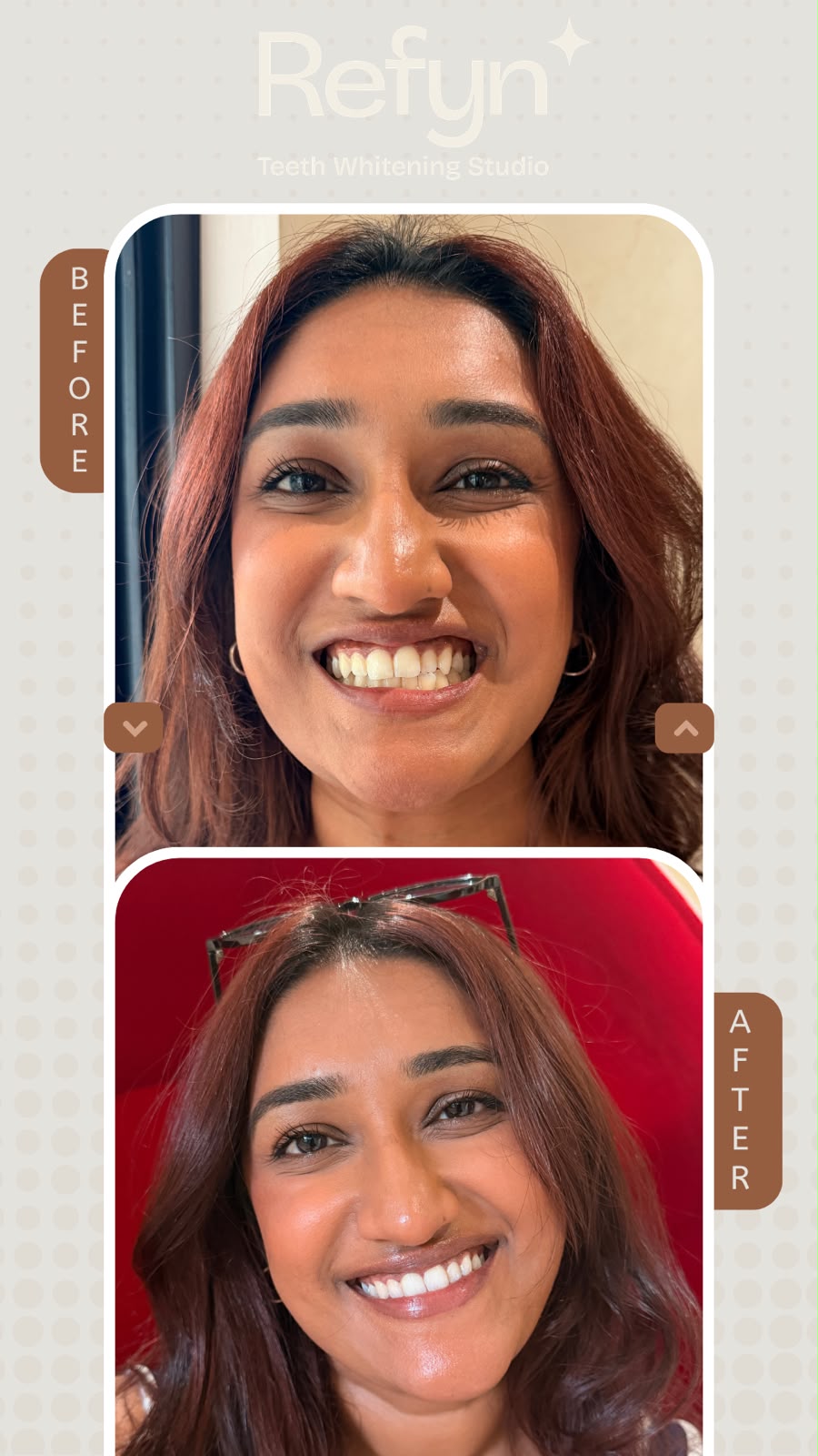 After teeth whitening — bright white smile