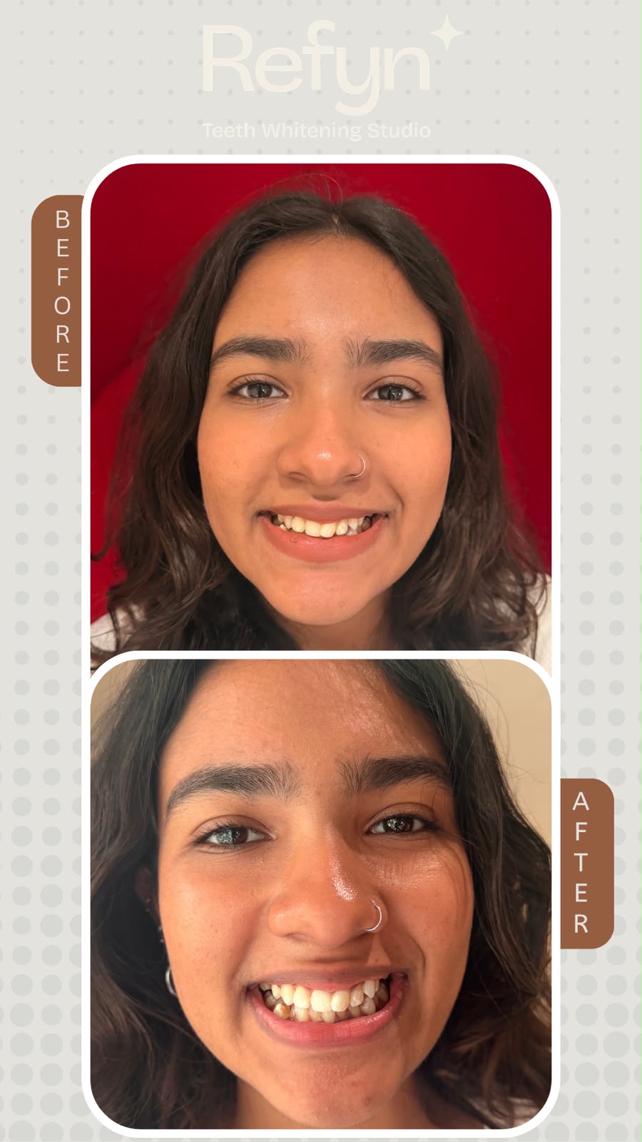 After teeth whitening — bright white smile