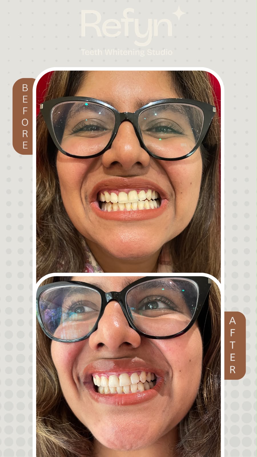 Before teeth whitening — stained enamel