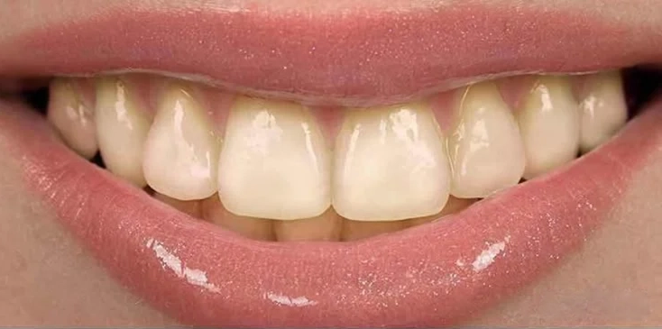 Before whitening