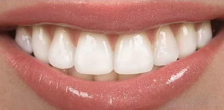 After whitening — bright smile