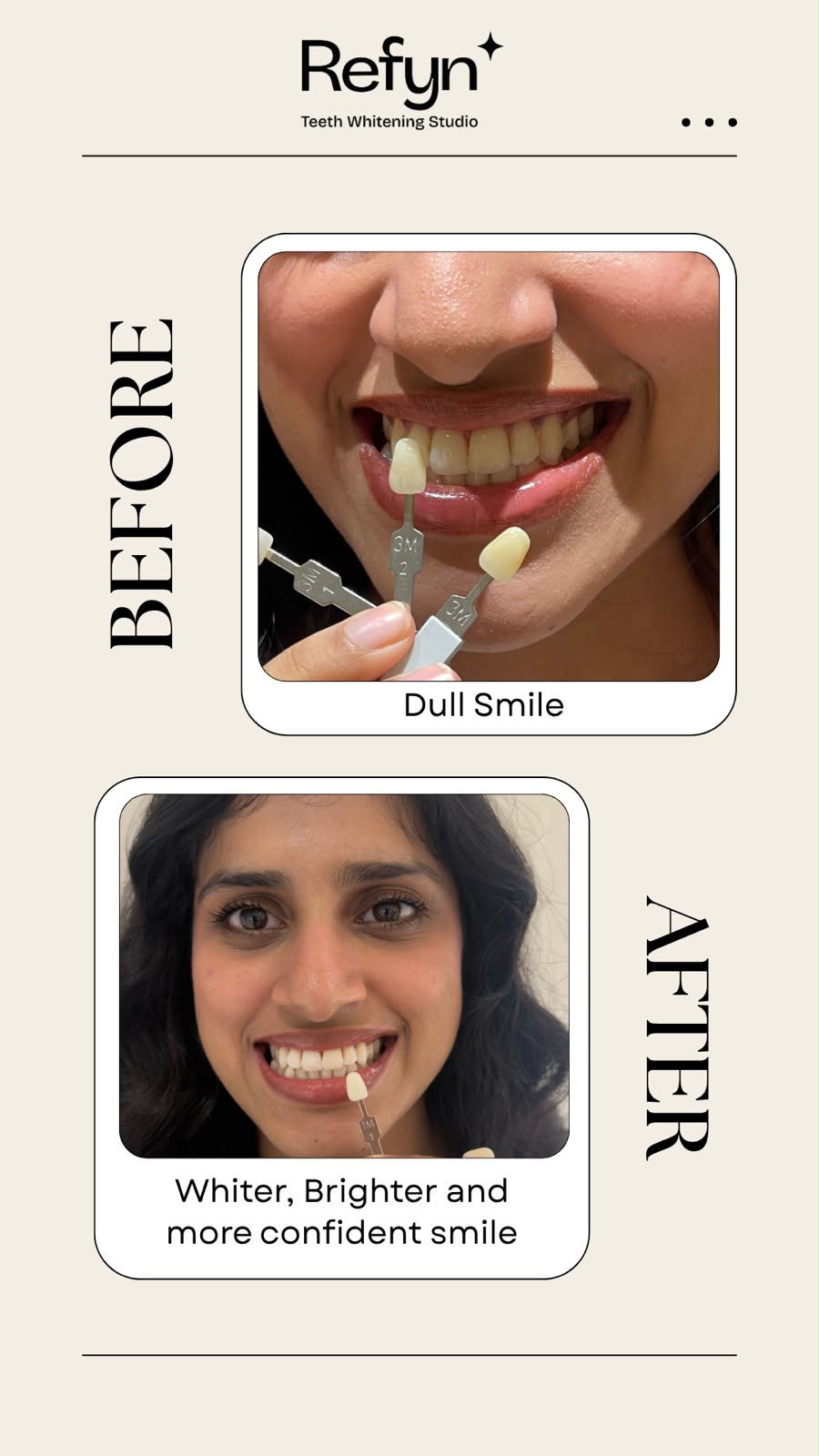 Before teeth whitening — stained enamel