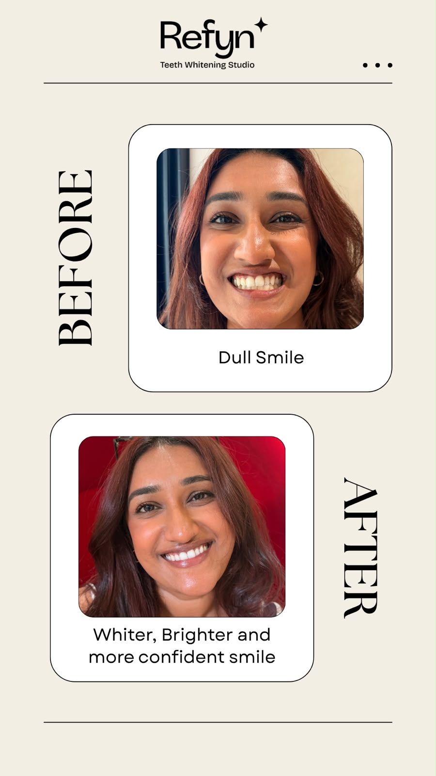 After teeth whitening — bright white smile