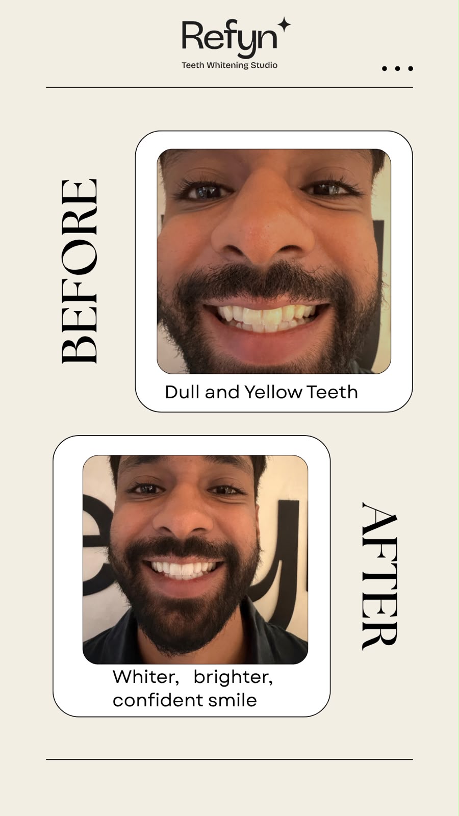 Before teeth whitening — stained enamel